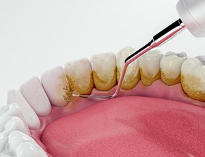 Illustration of plaque being removed from bottom teeth