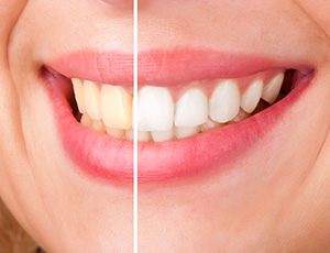 Closeup smile half before and half after whitening
