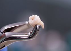Close up of forceps holding an extracted tooth