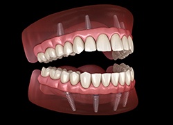 Implant dentures in Herndon