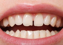 Invisalign can close minor gaps between the teeth