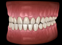 Invisalign can be used to correct an underbite