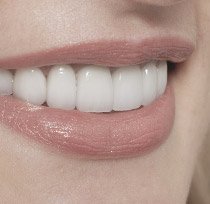 Closeup of a smile with straight white teeth