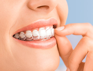 invisalign orthodontics surgery treatment orthodontic brackets system